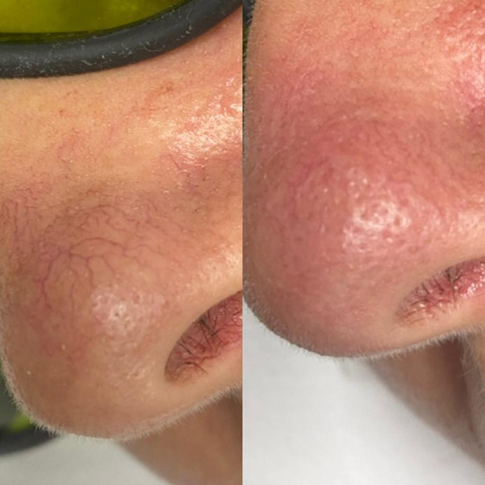 Antes y despues eliminación de várices